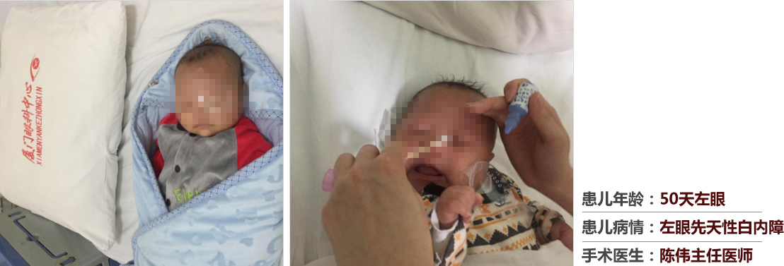 患兒年齡：50天左眼，患兒病情：左眼先天性白內(nèi)障，手術(shù)醫(yī)生：白內(nèi)障科陳偉主任醫(yī)師