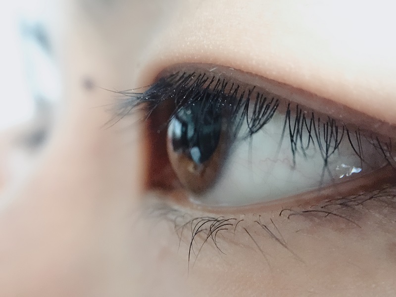 上眼皮為什么會(huì)下垂？上瞼下垂是怎么引起的？