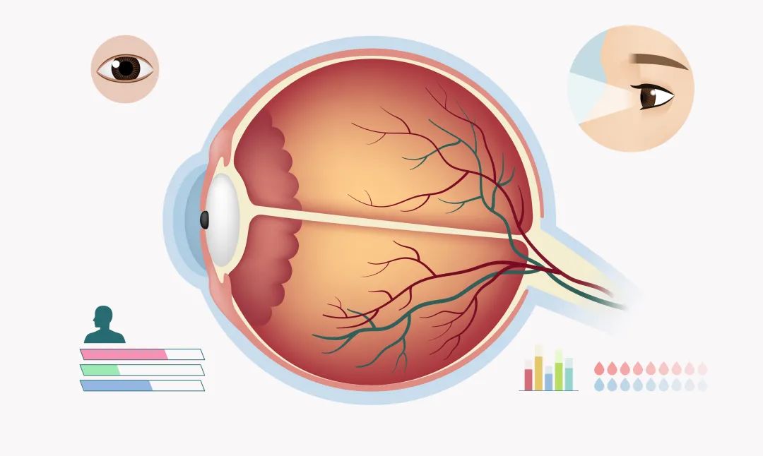 糖尿病視網膜病變分期