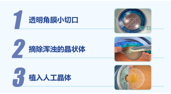 白內(nèi)障手術(shù)